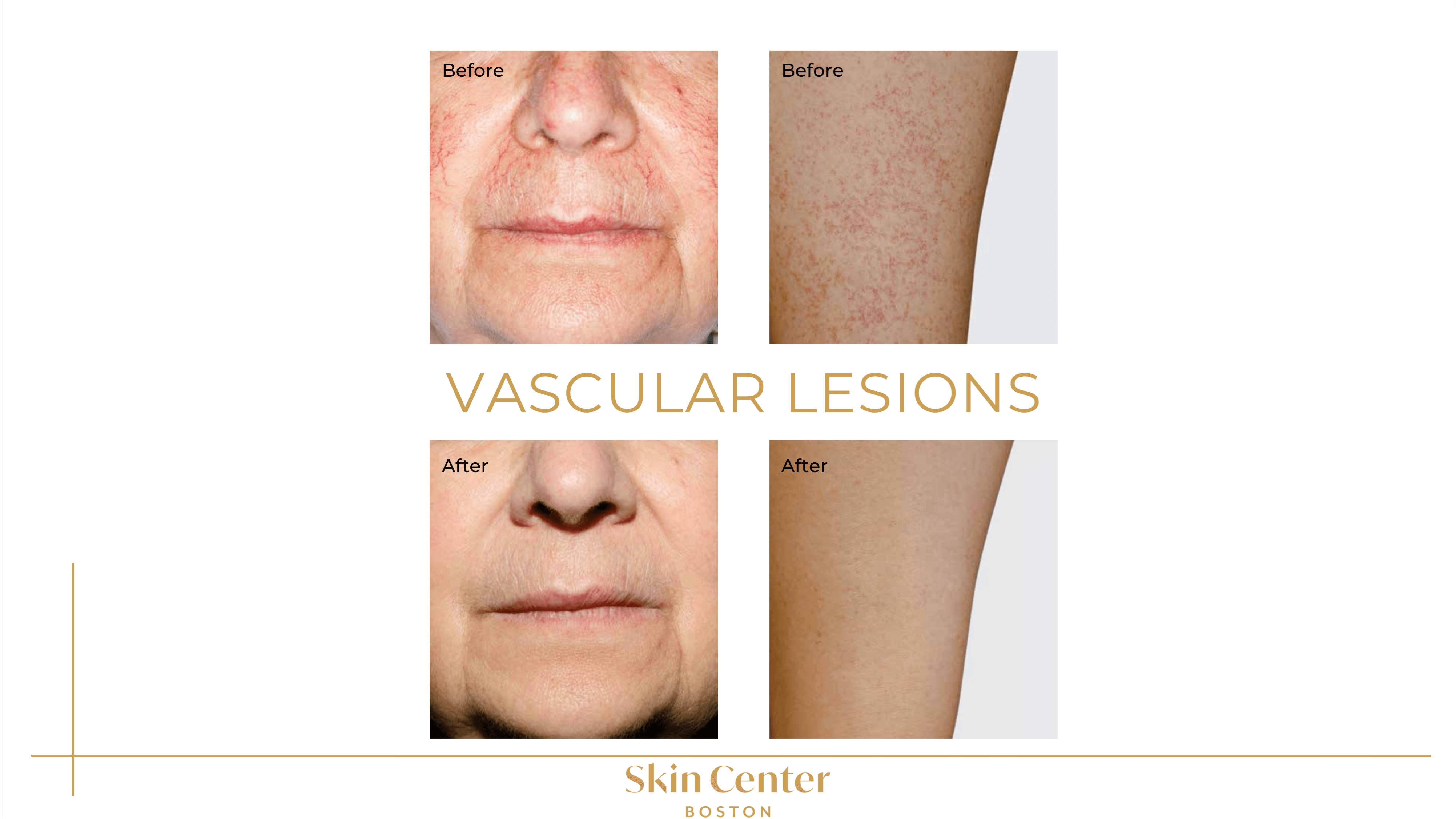 IPL - Vascular Lesions Before